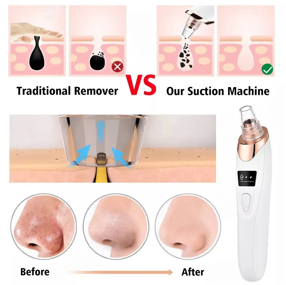 Multifunctional Cleaning Instrument – Deep Pore Cleanser & Blackhead Remover with Microdermabrasion